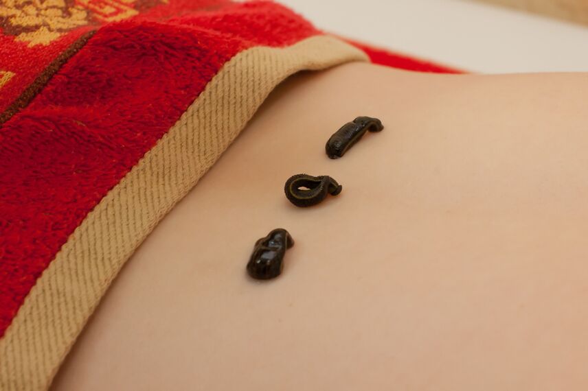 lipitori pe partea inferioară a spatelui cu osteocondroză