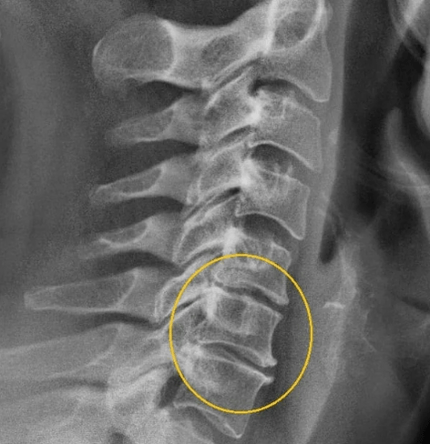 Osteochondroza cervicală